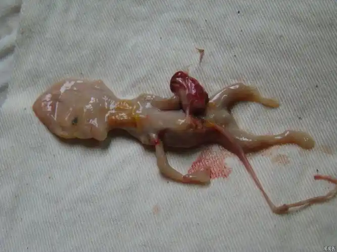 15:18:30前几天我科有一年轻的妇女因为死胎住院引产,引出的胎儿类似