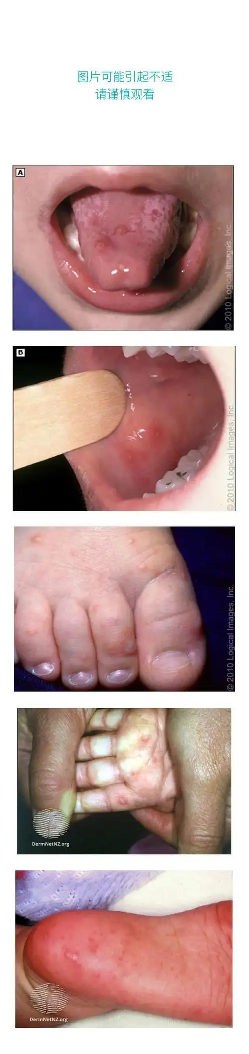 腺病毒疱疹性咽峡炎和手足口病患儿近期激增注意防范和科学护理