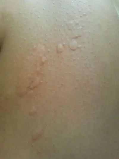 风疙瘩图片 (20)