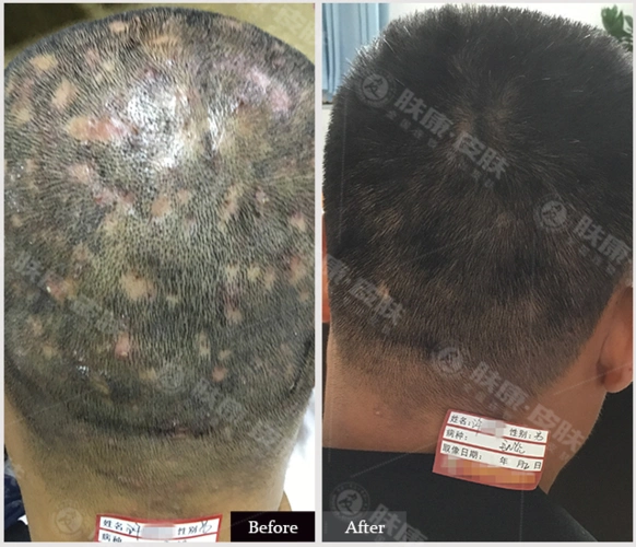 毛囊炎是整个毛囊细菌感染发生化脓性炎症.