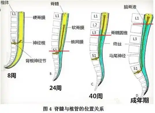 脊髓拴系综合征