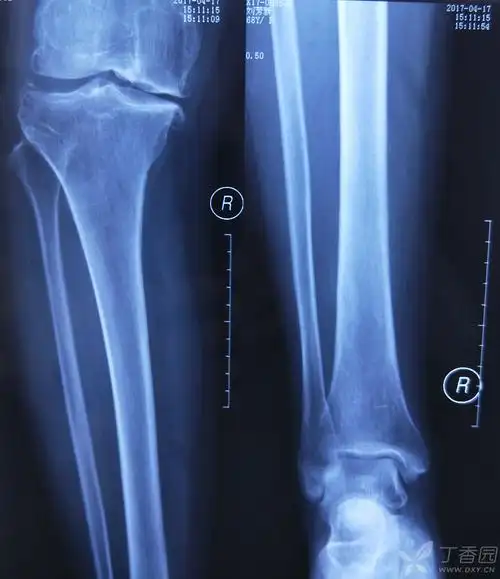 胫骨骨髓炎陈旧骨折如何治疗? [病例帖]