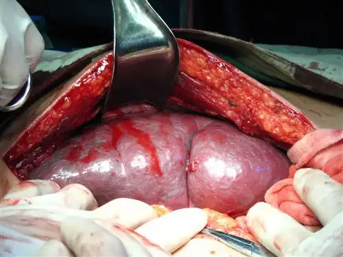 儿童脾大的症状有哪些