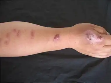 皮肤钙质沉着症胳膊结节结痂图