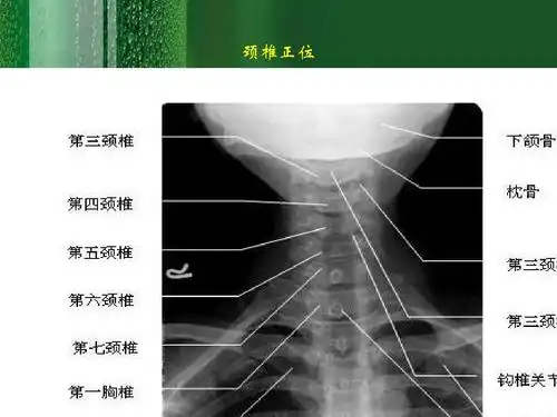 颈椎正位