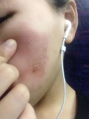 现在整块硬硬的脱皮.这是过敏么?怎么修复改善?