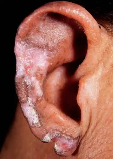 scle)为介于系统性红斑狼疮与盘状红斑狼疮之间的一种特殊的中间佬屯