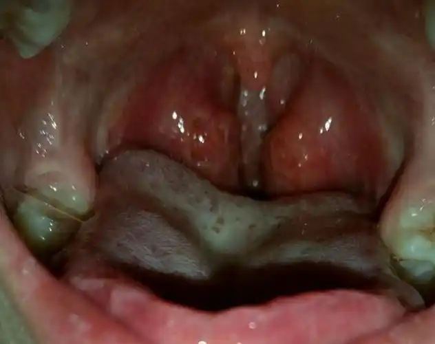 正常人的扁桃体图片