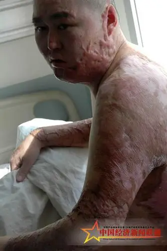 韩企童工烧伤80被扔在医院8个月无人管