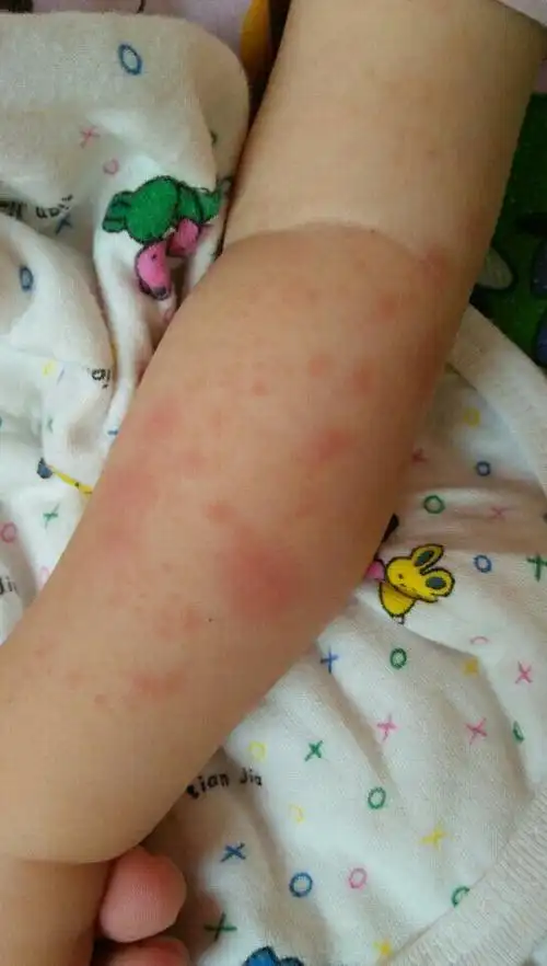 有宝宝有热疹和湿疹现象嘛怎么护理