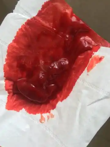 11周还大出血,有图辣眼睛