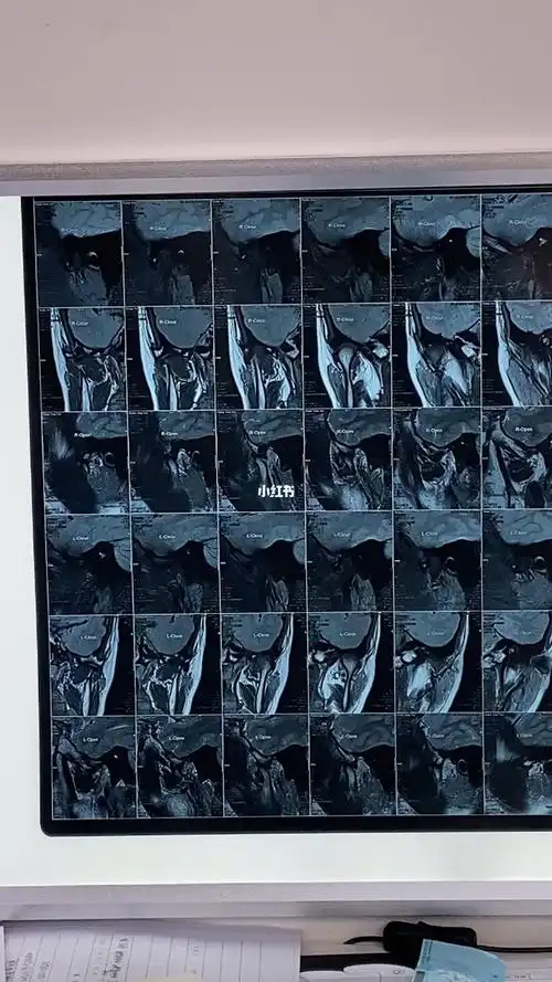 颞下颌关节核磁片子你会看吗