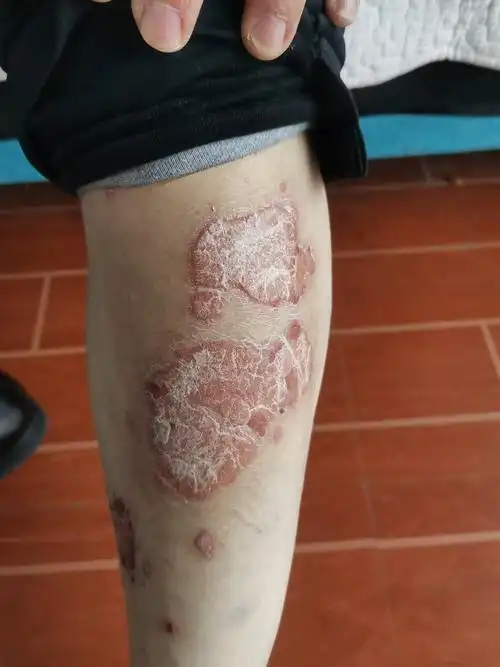 牛皮癣治疗不及时,当心惹上这三大危害