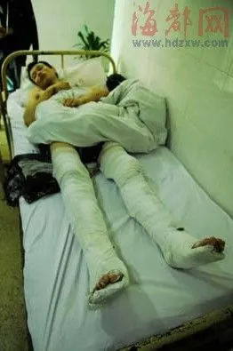 行窃的余某双腿被打断,孤零零地躺在医院里