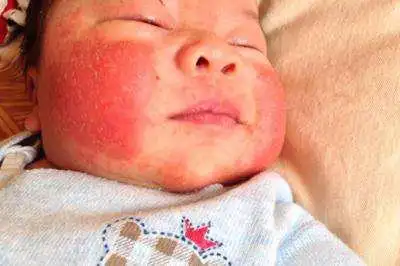 宝宝湿疹钻心刺骨的痒,儿科专家出良策:在湿疹上抹半斤它