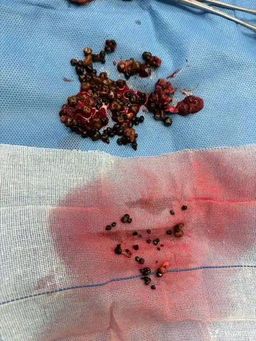 胆总管结石,胆囊多发结石并急性坏疽性胆囊炎,胆囊十二指肠内瘘