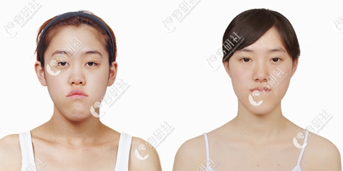 有没有能把长脸变短的手术?韩国改脸型口碑医院有哪些?