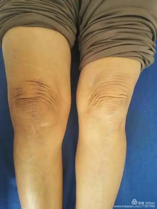 我院第一例人工膝关节置换术后病人术后4个月余复查.