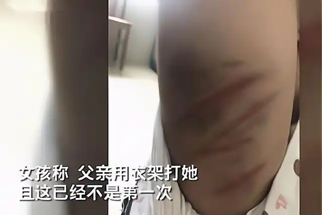 10岁女孩被用衣架暴打,满身伤痕,父亲:自家的事别人管不着