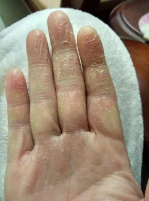 手足皲裂是手,足部皮肤由于各种原因所致的皮肤干燥和线状裂隙的一种