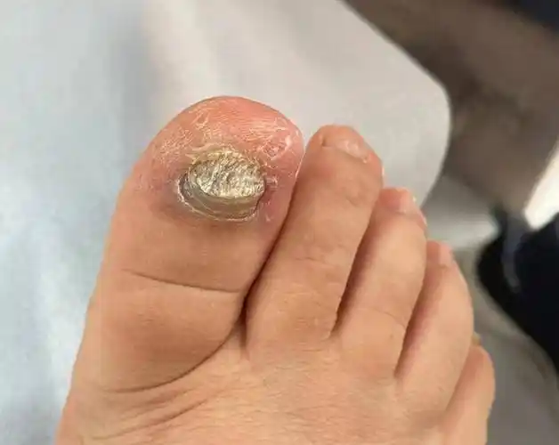 灰指甲一定要及时治疗,拖着只会越来越严重,还会传染给家人或传染到