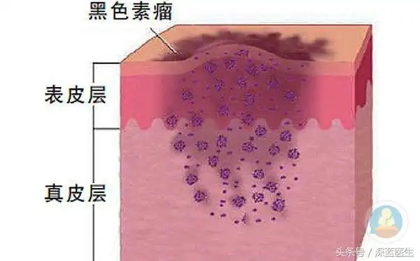 恶性黑色素瘤等于死亡心酸和无奈他是怎样维持了一年又一年