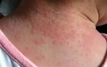 亚急性湿疹的症状是什么,怎么治疗? - 湿疹 - 重庆华肤皮肤病医院