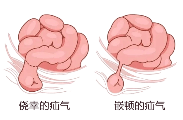 复杂疝气很罕见,凤城普外解疑难复杂腹股沟疝"斜疝 股疝"——"螺旋疝"