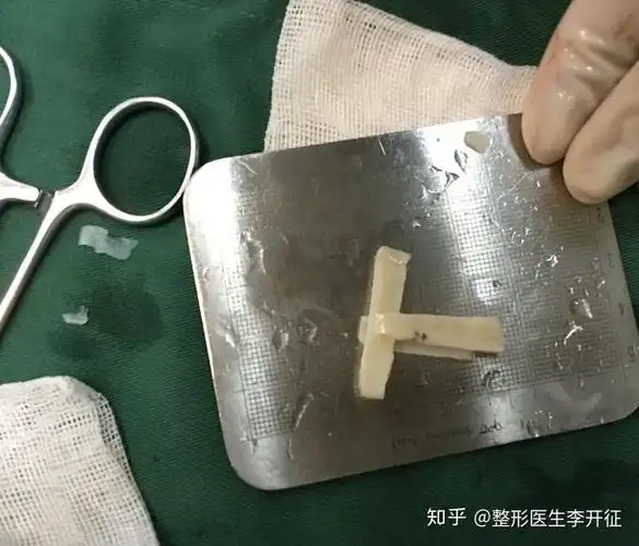 隆鼻的鼻支架怎么保持稳固? - 知乎