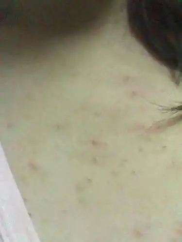 怀孕了胸前和背后长这种丁丁是什么原因,不痛不痒