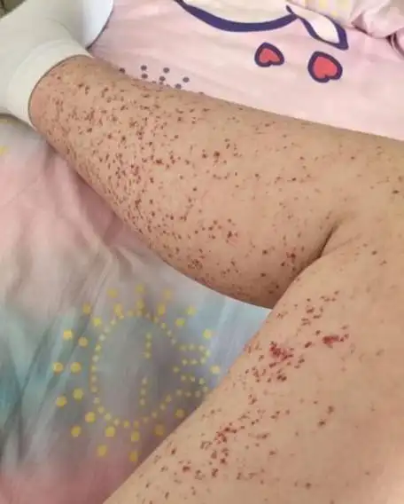 全面解析"过敏性紫癜"的危害及预防措施