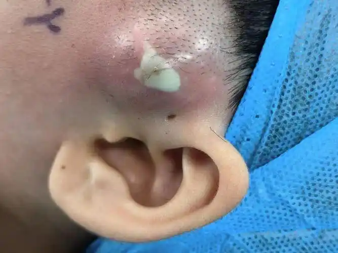 每天换药一周左右,控制感染后再等一个月手术切除耳前瘘管