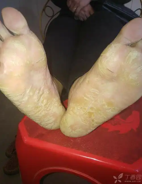 角化过度型足癣?