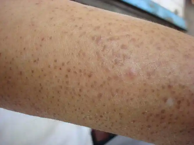 看图诊断18……毛周角化病