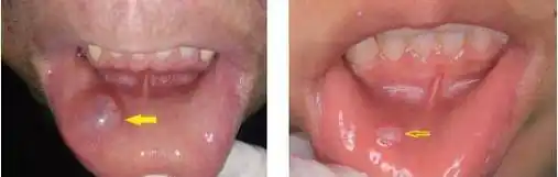 孩子舌头下长了个小肉团,原来是ta……_手术_黏液_舌下腺