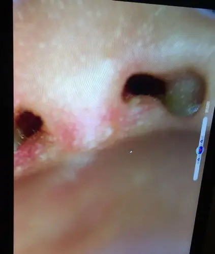 类似哨声 后来发现鼻子里有这个东西 不知道是不是鼻息肉还是正