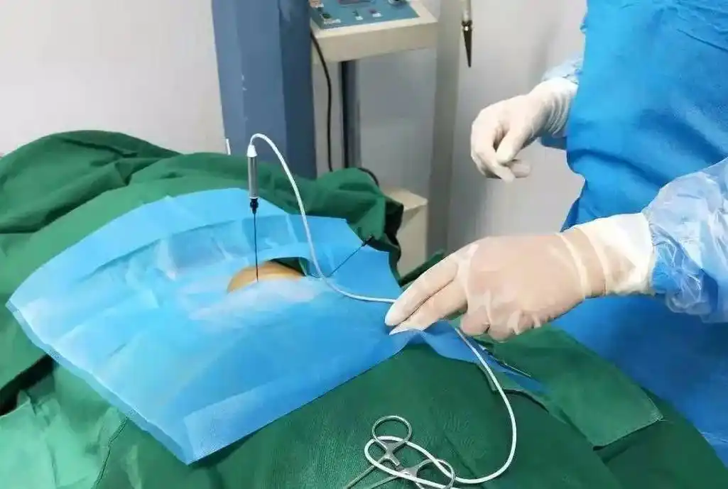 射频消融是一种介入手术的方法,主要是通过电极发射频繁变化的高 - 抖