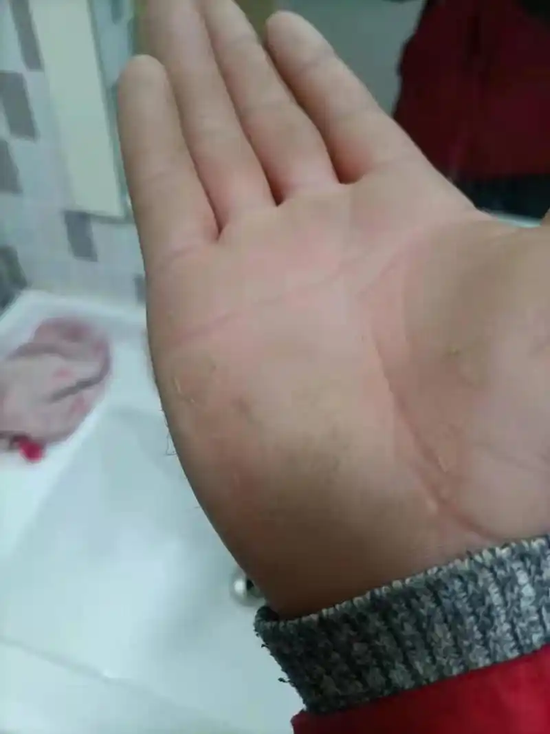 水源性肢端角化症治疗三天的效果 1,2图是治疗前接触水的情况 3图是