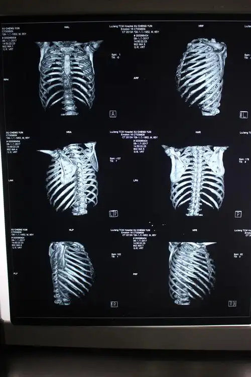 被车撞断了两根肋骨不够评伤残等级怎么办您还可以做三期鉴定维权