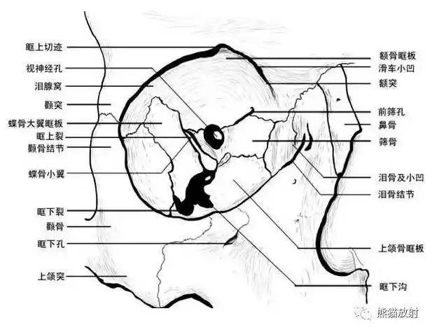 【急诊】眼眶爆裂性骨折的ct表现,眼眶解剖
