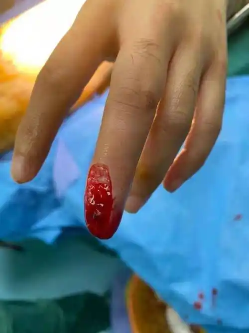原创咔嚓一刀剁下半个手指深圳医生从她肚子上挖肉种好新手指