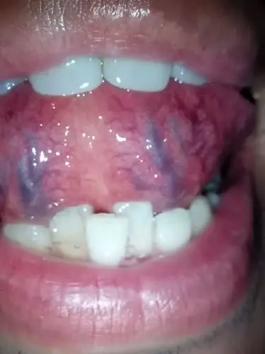 舌下青筋是什么问题