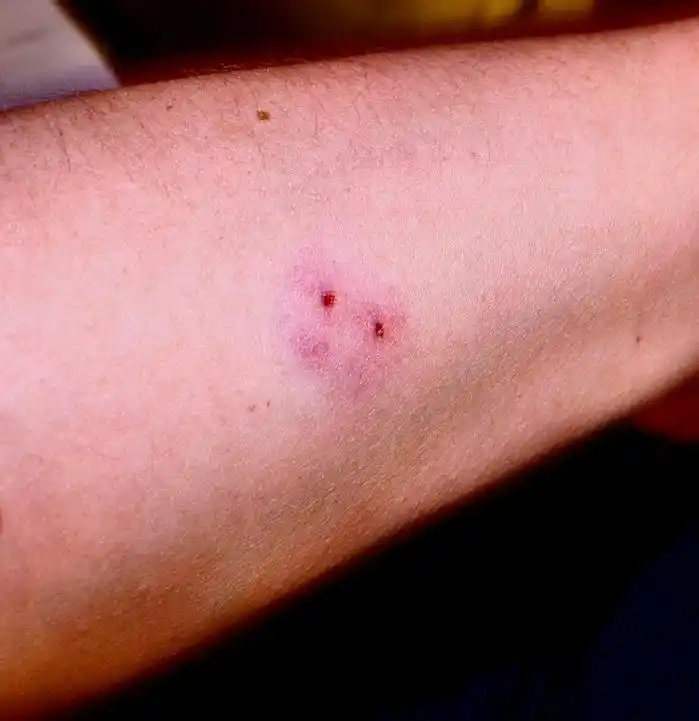 被毒蛇咬伤了,可以用嘴巴吸毒液吗?