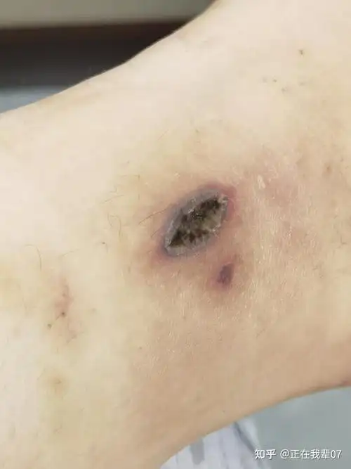 热水袋低温烫伤记录图片