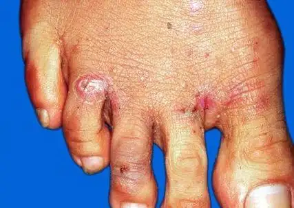 疥疮(scabies)系疥虫寄生于皮肤表皮内所致的慢性传染病,多发生于