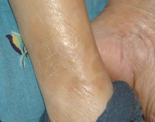 我八十多岁的奶奶腿上皮肤上这是什么病?