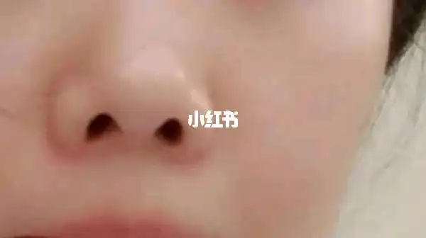 朝天鼻,挛缩鼻等鼻孔外露如何改善?