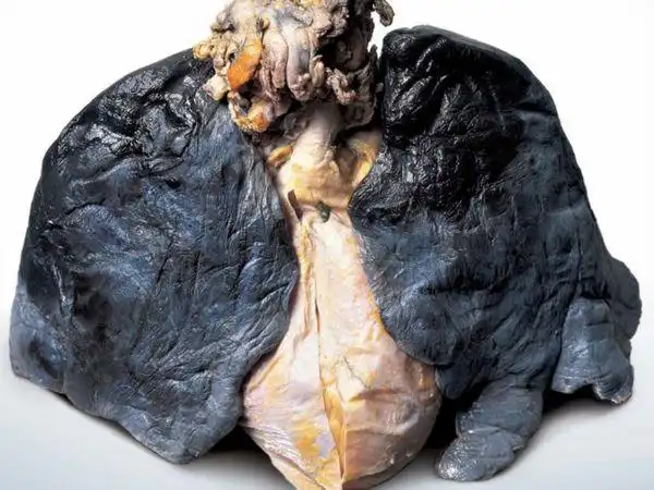 谁有吸烟着的肺的图片,要恶心的.