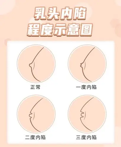 乳头内陷还有救吗