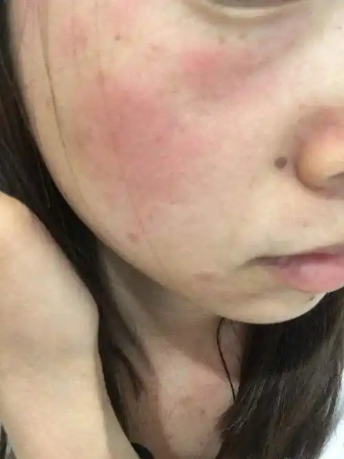 脸敷面膜过敏症状图片 敷面膜过敏是什么症状图片